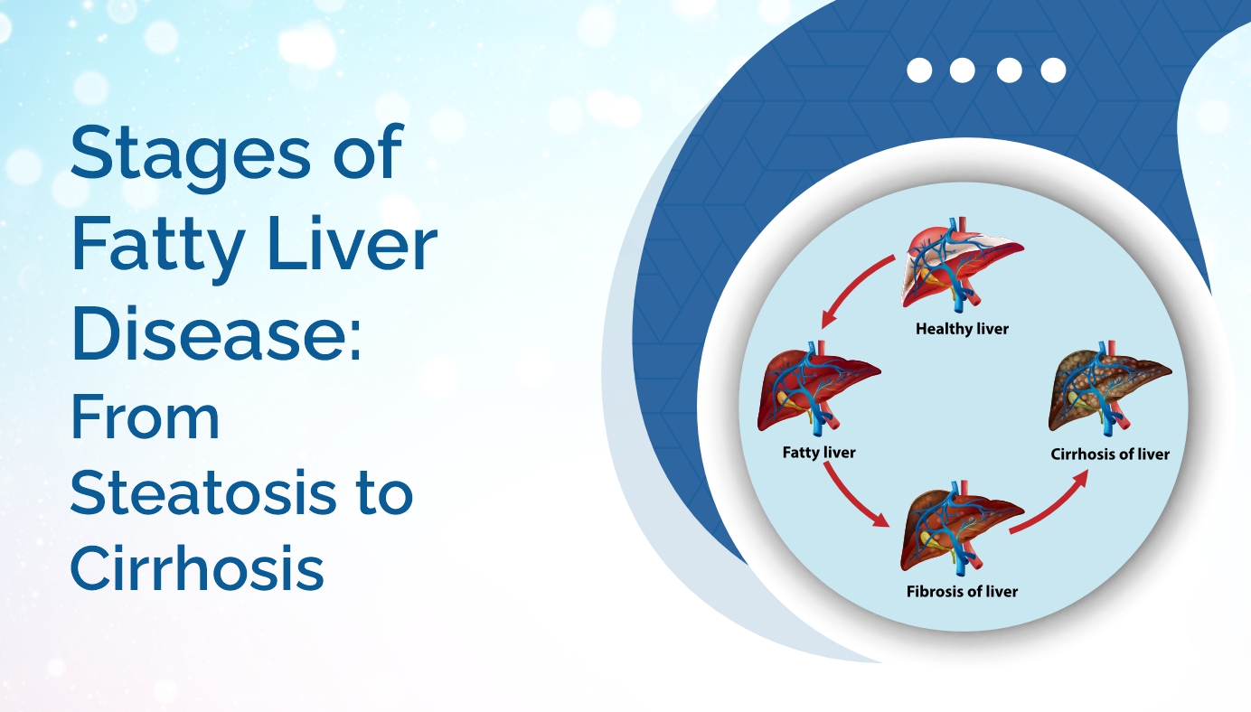 Stages of Fatty Liver Disease: From Steatosis to Cirrhosis